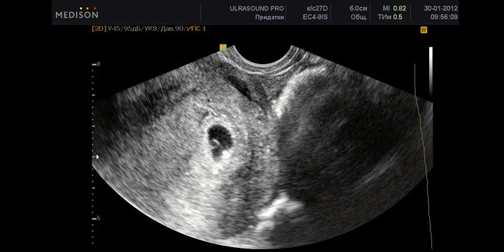 фото УЗИ на 5 неделе беременности