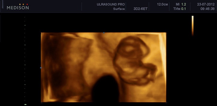 3D УЗИ на 9 неделе беременности