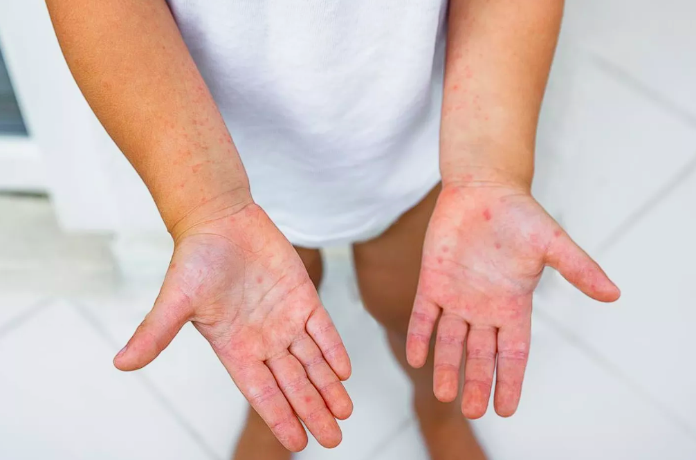 Вирус Коксаки у детей: как распознать первые симптомы и не перепутать с простудой